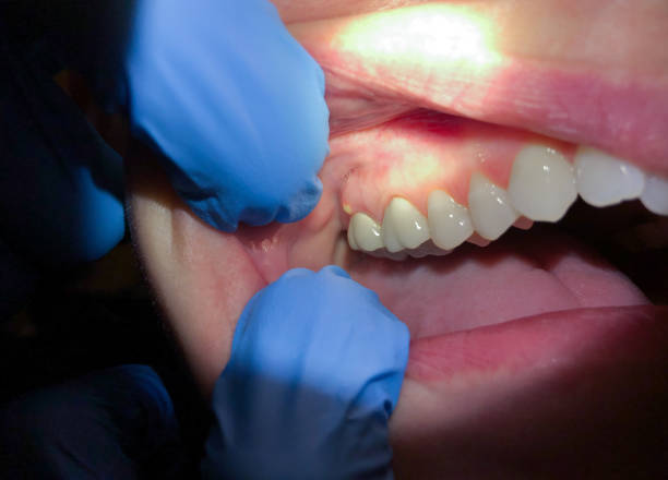 Best Emergency Dental Care for Broken or Chipped Teeth in Nicoma Park, OK